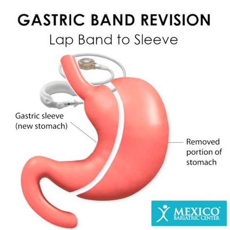 What Does Lap Band (Band Over) Gastric Bypass Procedures .